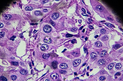 HCC Cells